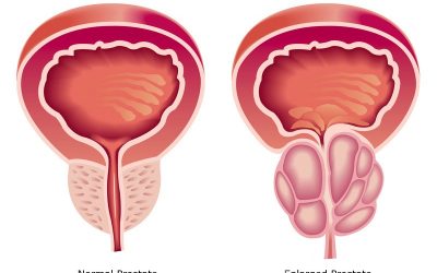 Le dieci domande piú frequenti sull’Ipertrofia Prostatica